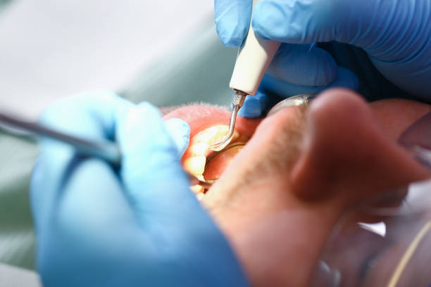 Best Emergency Treatment for Dental Infections or Abscesses in Perry, OH