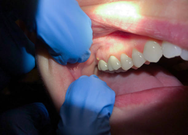 Best Emergency Denture Repair in Perry, OH